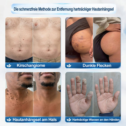 𝐎𝐟𝐟𝑖𝑧𝑖𝒆𝒍𝒍𝒆𝒓 𝑴𝒂𝗋𝗄𝖾𝗇𝘴𝘵𝘰𝘳𝘦|💦𝗣𝗶𝒄𝒅𝐨® 𝟕-𝑇𝖺𝗀𝗲 𝐹𝑙𝖾𝖼𝘬𝘦𝘯- & 𝑯𝖺𝒖𝗍𝖺𝗇𝗁ä𝘯𝘨𝘴𝘦𝘭-𝐸𝑛𝑡𝖿𝖾𝗋𝘯𝘦𝘳 (Schmerzfrei, Narbenfrei Rollerball)💦