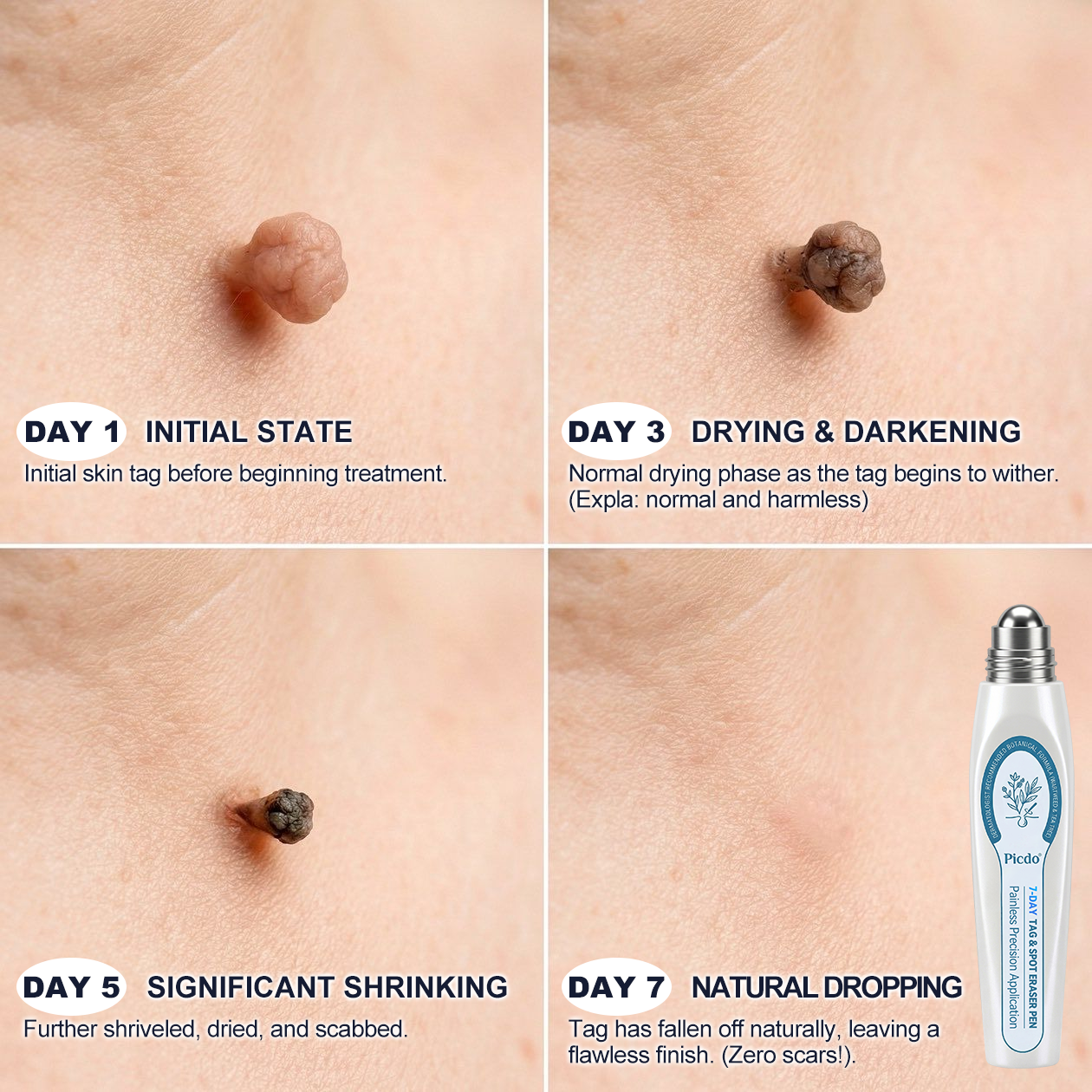 𝐎𝐟𝐟𝑖𝑧𝑖𝒆𝒍𝒍𝒆𝒓 𝑴𝒂𝗋𝗄𝖾𝗇𝘴𝘵𝘰𝘳𝘦|💦𝗣𝗶𝒄𝒅𝐨® 𝟕-𝑇𝖺𝗀𝗲 𝗘𝗻𝘵𝘧𝘦𝘳𝑛𝑒𝑟 𝑓ü𝘳 𝘏𝘢𝘶𝘁𝗮𝗻𝗵ä𝗇𝗀𝗌𝖾𝗅 & 𝐹𝑙𝑒𝐜𝐤𝖾𝗇 (schmerzfreier Rollerball ohne Narben)💦