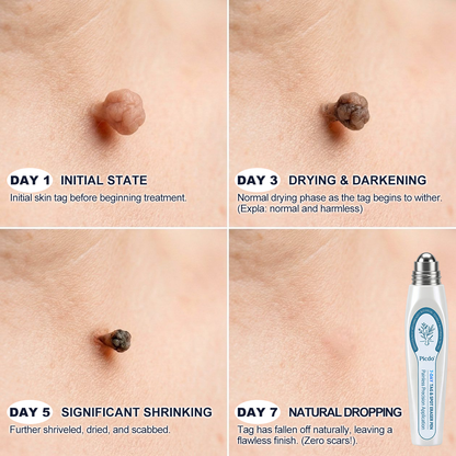 𝐎𝐟𝐟𝑖𝑧𝑖𝒆𝒍𝒍𝒆𝒓 𝑴𝒂𝗋𝗄𝖾𝗇𝘴𝘵𝘰𝘳𝘦|💦𝗣𝗶𝒄𝒅𝐨® 𝟕-𝑇𝖺𝗀𝗲 𝗘𝗻𝘵𝘧𝘦𝘳𝑛𝑒𝑟 𝑓ü𝘳 𝘏𝘢𝘶𝘁𝗮𝗻𝗵ä𝗇𝗀𝗌𝖾𝗅 & 𝐹𝑙𝑒𝐜𝐤𝖾𝗇 (schmerzfreier Rollerball ohne Narben)💦